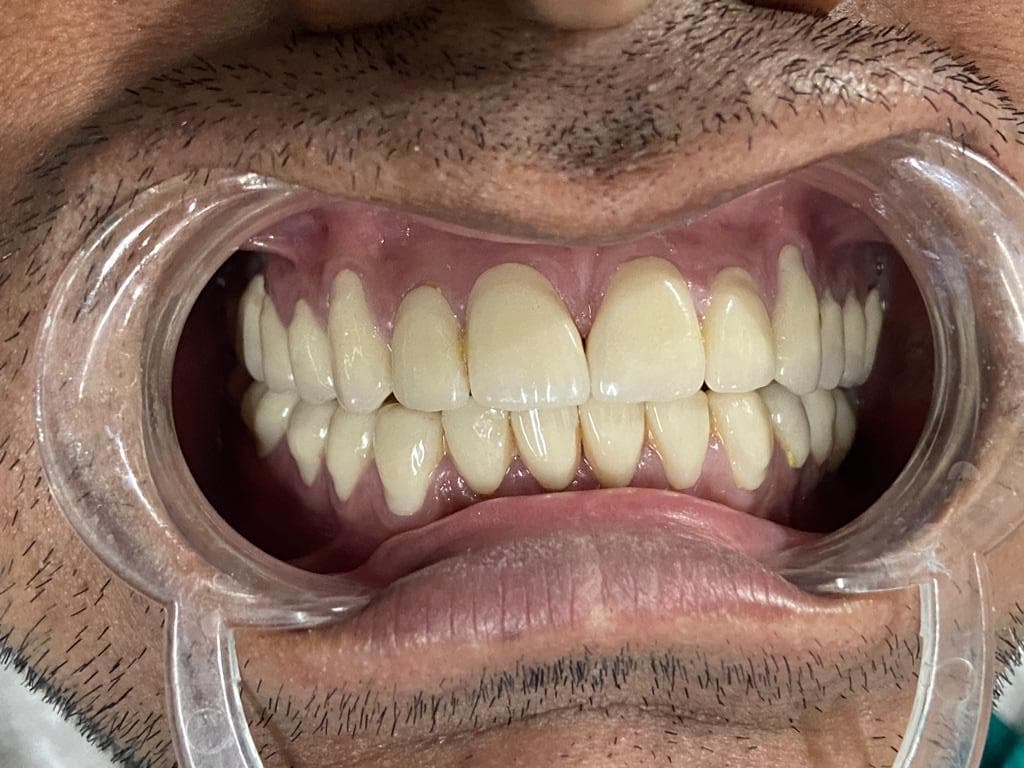 Smile Makeover After