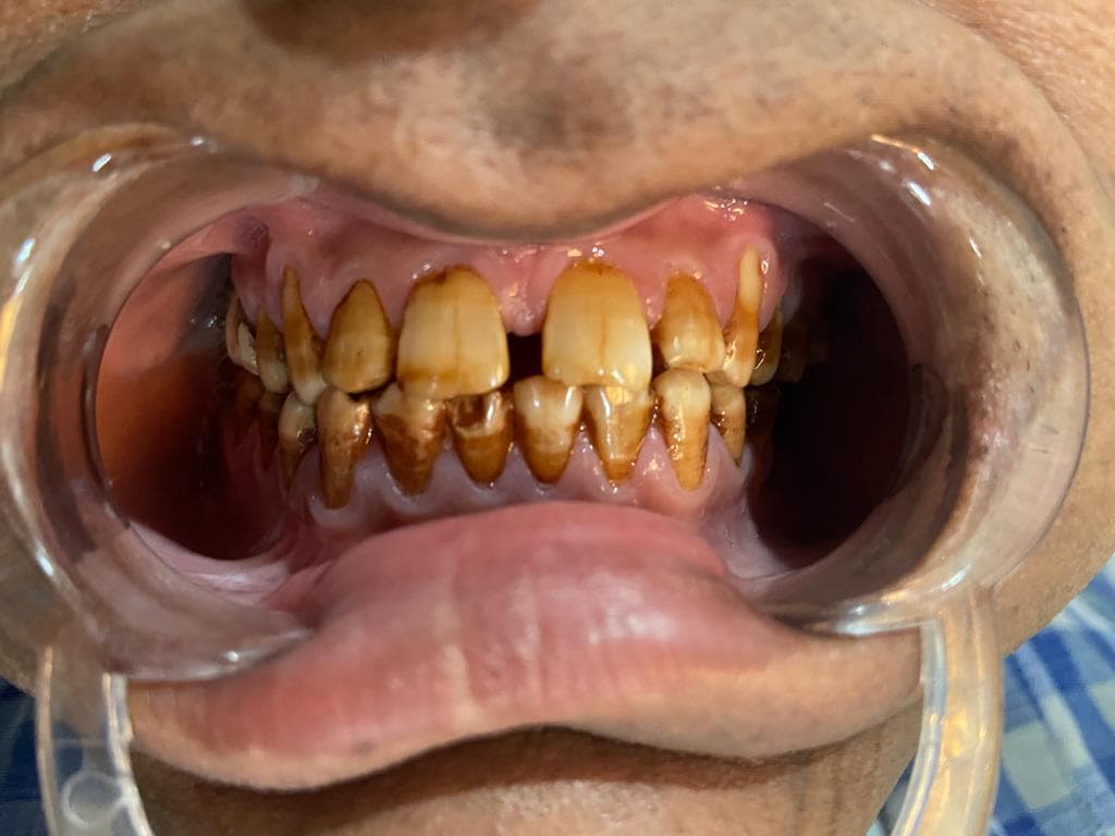 Smile Makeover Before