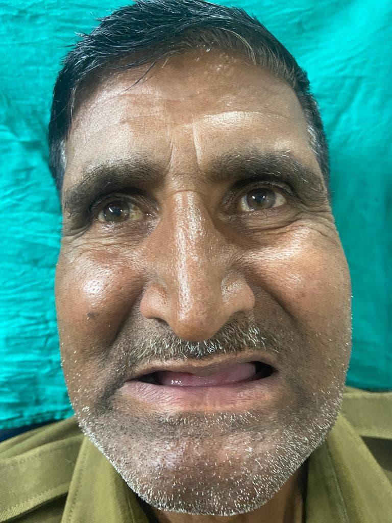 Dental Implants Before