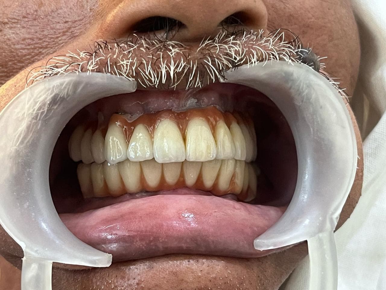 Dental Implants After