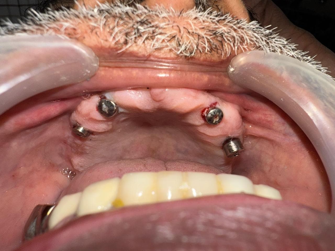 Dental Implants Before